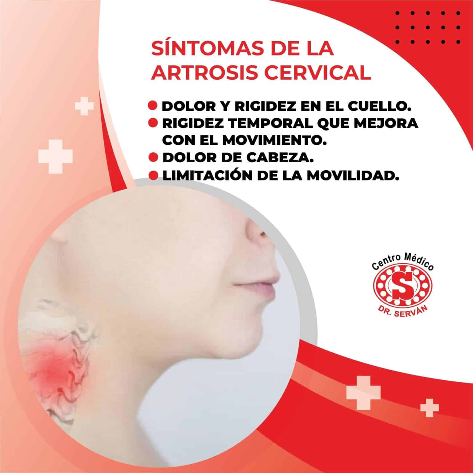 Síntomas de la artrosis cervical Centro Médico Dr Serván