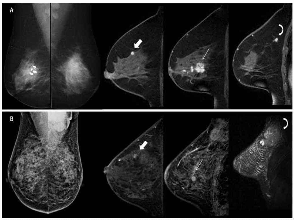 Resonancia Magnética – Mama – Centro Médico Dr Serván